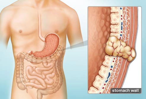 GIST được nghi ngờ và phát hiện dựa trên các triệu chứng như thiếu máu, đau bụng...