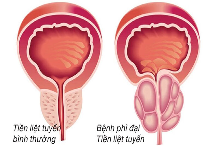 Phì đại tiền liệt tuyến là sự gia tăng kích thước của tuyến tiền liệt